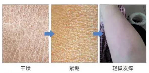 化妆品,皮肤,保湿,皮肤干燥,成分,角质层