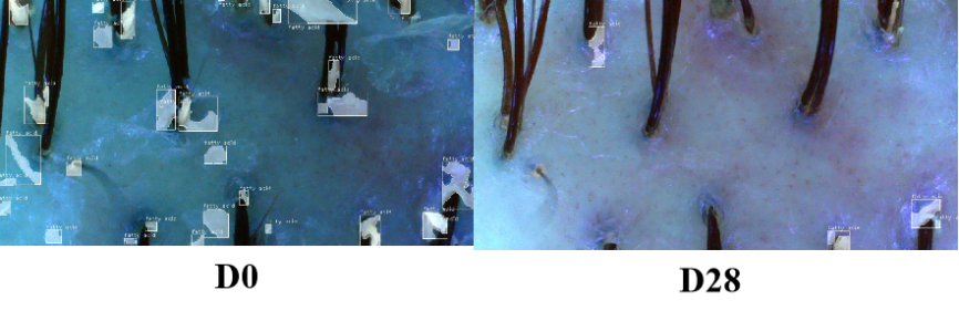 头皮,健康,头皮脱屑,头皮皮脂