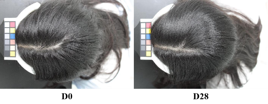 头皮,健康,头皮脱屑,头皮皮脂